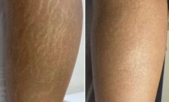 Ferramenta de autoestima: Saiba mais sobre tatuagem estética