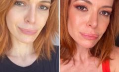 Atriz e apresentadora Babi Xavier faz procedimento facial com bioestimuladores