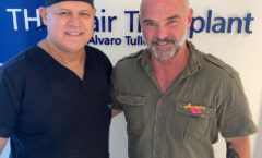 Ator Mateus Carrieri é o mais novo galã que passa por cirurgia de Transplante Capilar em SP