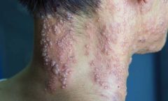 Herpes Zóster: o que é, como prevenir e como tratar