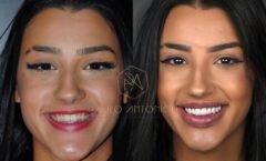 Bia Miranda exibe novo sorriso após colocar lentes de contato