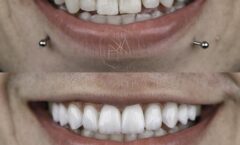 Mitos e verdades sobre Lentes de contato dental