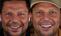 Após vencer reality, Thiago Servo muda o visual e investe R$ 30 mil em lentes de contato dental e clareamento