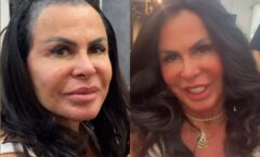 Gretchen fala sobre alopecia: “Não tenho mais cabelo”